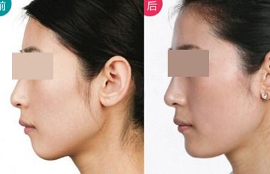 上海哪個(gè)醫(yī)生擅長鼻翼縮??？2023年度網(wǎng)民口碑推薦醫(yī)生名冊(cè)曝光
