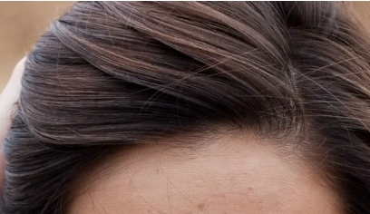 南昌二附院整形科眼袋抽脂效果好嗎？值得醫(yī)生推薦嗎？