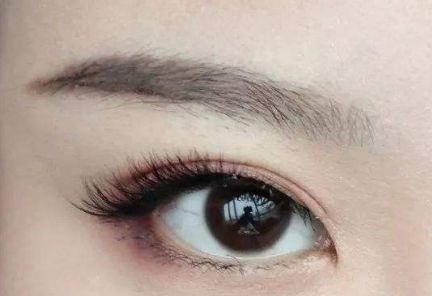 大連王琳雙眼皮的完美實(shí)踐，80天親身體驗(yàn)揭秘