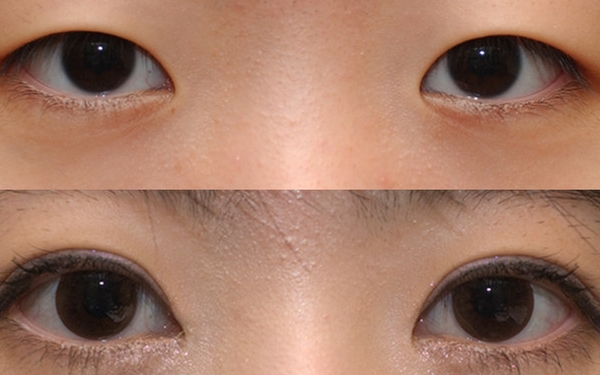 上海哪家醫(yī)院做眼袋手術價格實惠又靠譜？排行榜前十強！