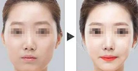 石家莊最受歡迎的除皺美容醫(yī)院排名榜前六來襲！2023年超贊抗衰除皺全攻略！