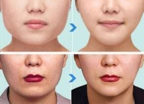 杭州哪家醫(yī)院做下頜角整形效果好？綜合口碑、價格受好評的幾家醫(yī)院推薦