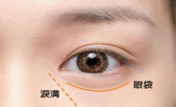 深圳哪家醫(yī)院割雙眼皮技術(shù)獨步全球？高水平專家團隊助力