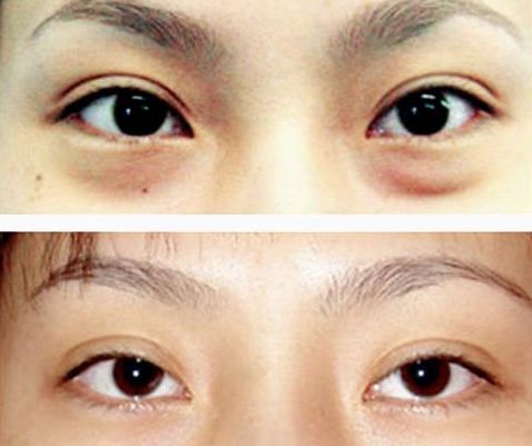 謝錦清：醫(yī)術(shù)高超，雙眼皮案例解析曝光！