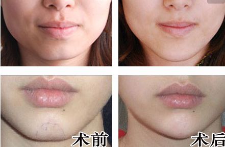 廣州人中縮短手術(shù)醫(yī)生推薦？網(wǎng)友真實(shí)評(píng)價(jià)與信息公開！