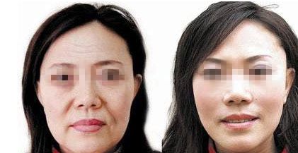 成都自然雙眼皮去哪家醫(yī)院靠譜？