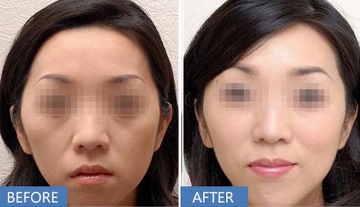 上海哪家醫(yī)院做打玻尿酸除皺效果好？