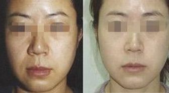 王自謙脂肪移植，存活率高受追捧