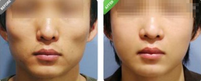 深圳哪家醫(yī)院的拉皮除皺效果最好？排名前幾位的醫(yī)院有哪些？