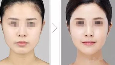 長沙雙眼皮整形醫(yī)院推薦，哪家效果更好？