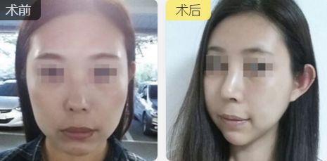 合肥雙眼皮整形推薦：口碑好、技術(shù)精湛、性價(jià)比高的醫(yī)生