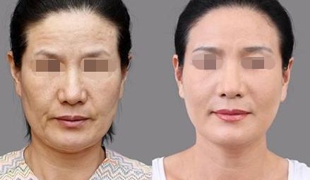 徐州哪家醫(yī)院割雙眼皮效果好？前四名醫(yī)院盤點(diǎn)