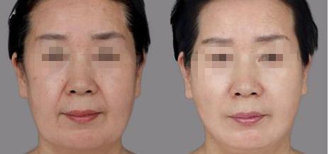 樂(lè)山哪家整形醫(yī)院雙眼皮比較好？匯總單六強(qiáng)預(yù)測(cè)