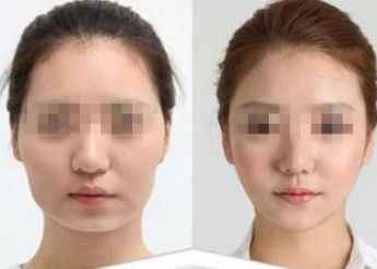 南寧市哪家醫(yī)院做雙眼皮好？