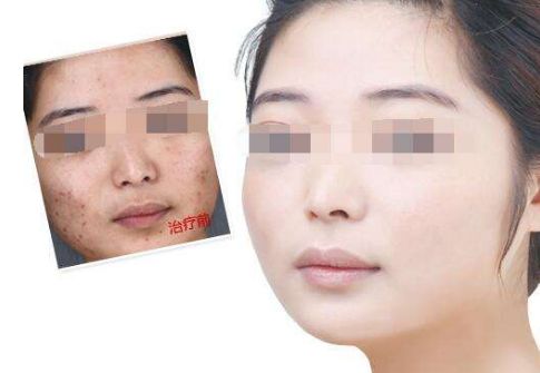 廣州肚皮上的妊娠紋如何有效修復(fù)？
