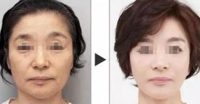 西安哪家醫(yī)院擅長(zhǎng)面部輪廓整形？