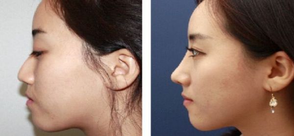 北京大腿抽脂專家推薦，哪個(gè)醫(yī)院技術(shù)好？