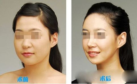 肌功能矯治，哪個階段適合兒童早期干預(yù)？哪些醫(yī)院堪稱專家？