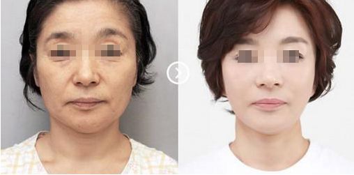 蘇州奧克拉醫(yī)院的整形效果及評價如何？