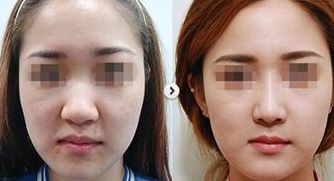 上海愛爾眼科醫(yī)院近視眼視力矯正方案解析：技術(shù)、價(jià)格、醫(yī)生介紹全攻略