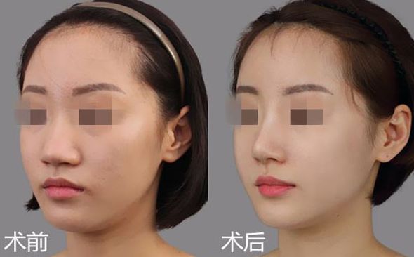 江門哪家醫(yī)院割雙眼皮效果好? 江門哪家醫(yī)院割雙眼皮效果好?