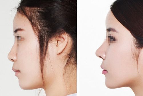 汕頭名流整形醫(yī)院：拉雙眼皮、吸脂價(jià)格一覽，專家解讀真實(shí)案例