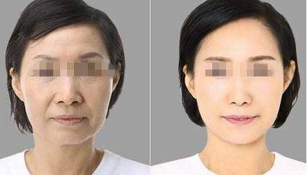 寧波玻尿酸去法令紋效果評價一覽 寧波玻尿酸去法令紋效果評價一覽