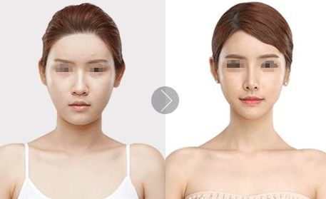 北京植發(fā)醫(yī)院推薦，哪家效果好？