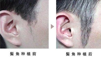 開眼角手術(shù)改善眼型，揭秘適合人群