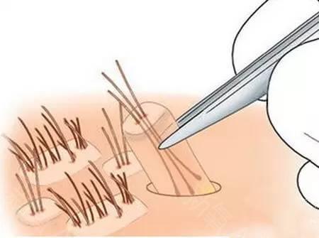 全國著名植發(fā)醫(yī)院排行榜！推薦您前往上海九院、新生等頂級機(jī)構(gòu)