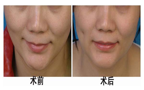 湖州雙眼皮手術(shù)機構(gòu)推薦：3家優(yōu)質(zhì)醫(yī)院完美整形，放心選擇