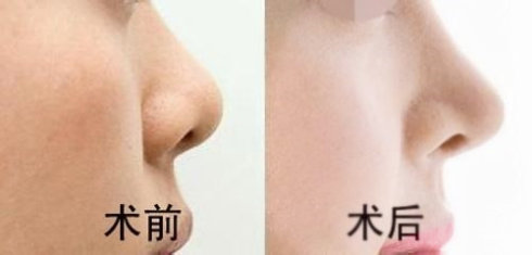 重慶現在有哪些當代鼻子整形醫(yī)生值得關注？參考謝錦清和曾高醫(yī)生的口碑評價