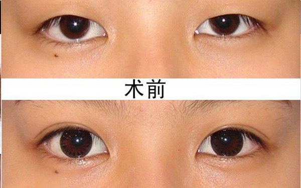 2023西安鼻基骨縮窄手術(shù)醫(yī)院排名前10強(qiáng)，值得信賴的口碑推薦！