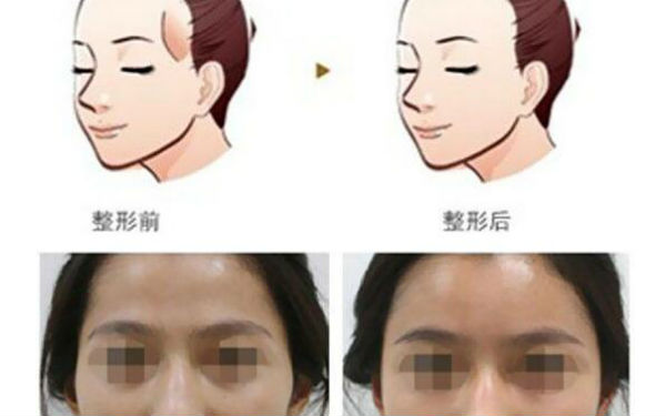 洛陽哪家醫(yī)院做木偶紋效果好？2023榜單出爐，洛陽物理去木偶紋top10佳選露面！