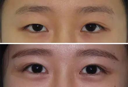 杭州駝峰鼻矯正哪家整形醫(yī)院技術(shù)獨特？2023杭州駝峰鼻矯正排名前10的醫(yī)院評測揭曉！