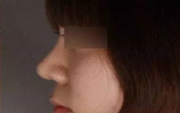 重慶哪家整形醫(yī)院祛黑眼圈效果靠譜？2023年重慶祛黑眼圈醫(yī)療機構排名前十值得信賴嗎？