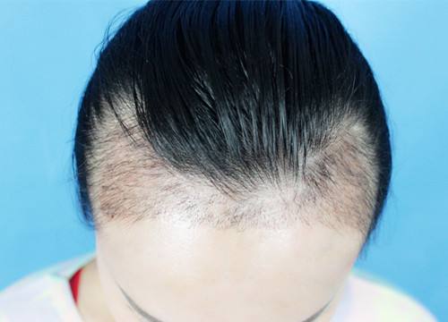 宜賓市哪家整形醫(yī)院專業(yè)豐額頭術(shù)效果好？探尋宜賓自體脂肪豐額頭術(shù)醫(yī)院口碑佳！2023宜賓豐額頭術(shù)推薦前十技