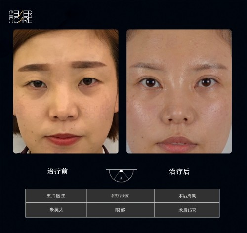 阿爾法9°美眼，打開視界，美無止境
