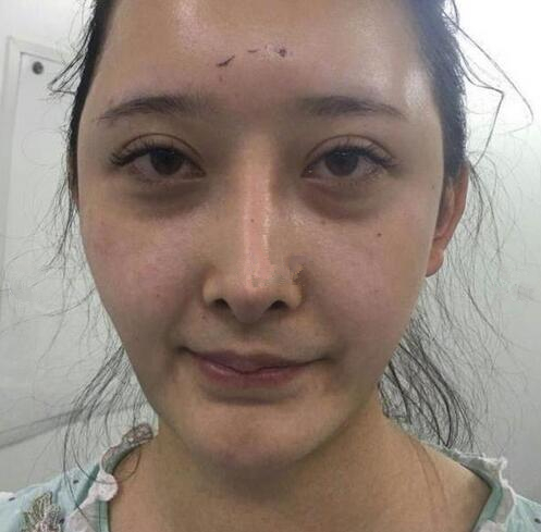 深圳陽光全臉填充術(shù)前術(shù)后對比，說年輕十歲不過分吧