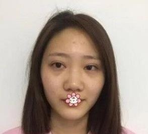北京彤美耳軟骨隆鼻三個月效果分享，吐血推薦