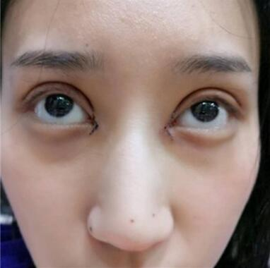 雙眼皮失敗丑的不敢見(jiàn)人，昆明麗都整形雙眼皮修復(fù)案例分享