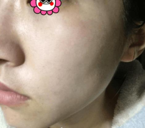 困惱我多年的斑，沒想到在溫州韓美三千塊錢就去掉了