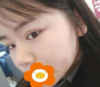 據(jù)說杭州薇琳隆鼻后效果很自然，有案例嗎