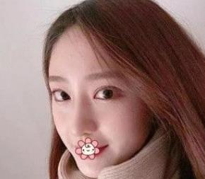 北京彤美耳軟骨隆鼻三個月效果分享，吐血推薦