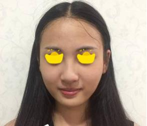 塌鼻子小妹在深圳鵬愛做隆鼻手術(shù)，三個月后竟然是這樣的