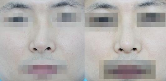 不要被營銷號帶偏了，鼻骨矯正其實很簡單
