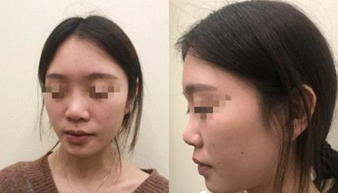 耳軟骨隆鼻術(shù)后三個(gè)月，我有了韓佳人同款美鼻