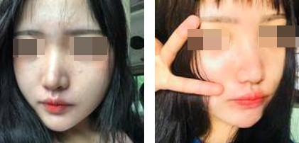 一個(gè)鼻子讓一張臉迅速高級(jí)，還不考慮做個(gè)鼻綜合嗎