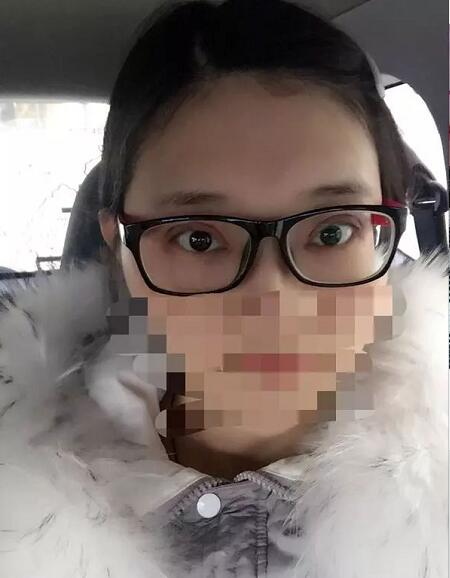 北京京民雙眼皮修復(fù)案例分享，說(shuō)是媽生眼我都信