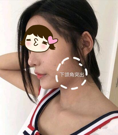 廣州美恩整形下頜角術(shù)后三個(gè)月反饋，真實(shí)效果看得見